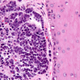 Merkel cell carcinoma (Image: Nephron/Wikimedia Commons)
